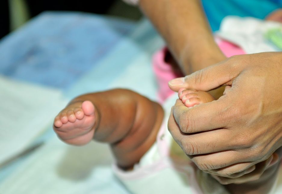 World Clubfoot Day: South Africa's fight for equitable treatment