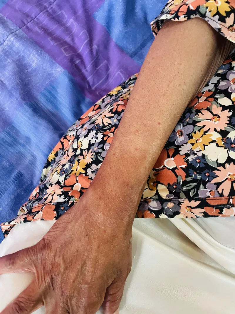 Kukhalwa ngesibhedlela ngoshone ekhala ngomiyane