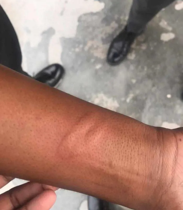 Another learner at Luhlaza Secondary School alleges this swollen area was caused after being struck by a teacher. 