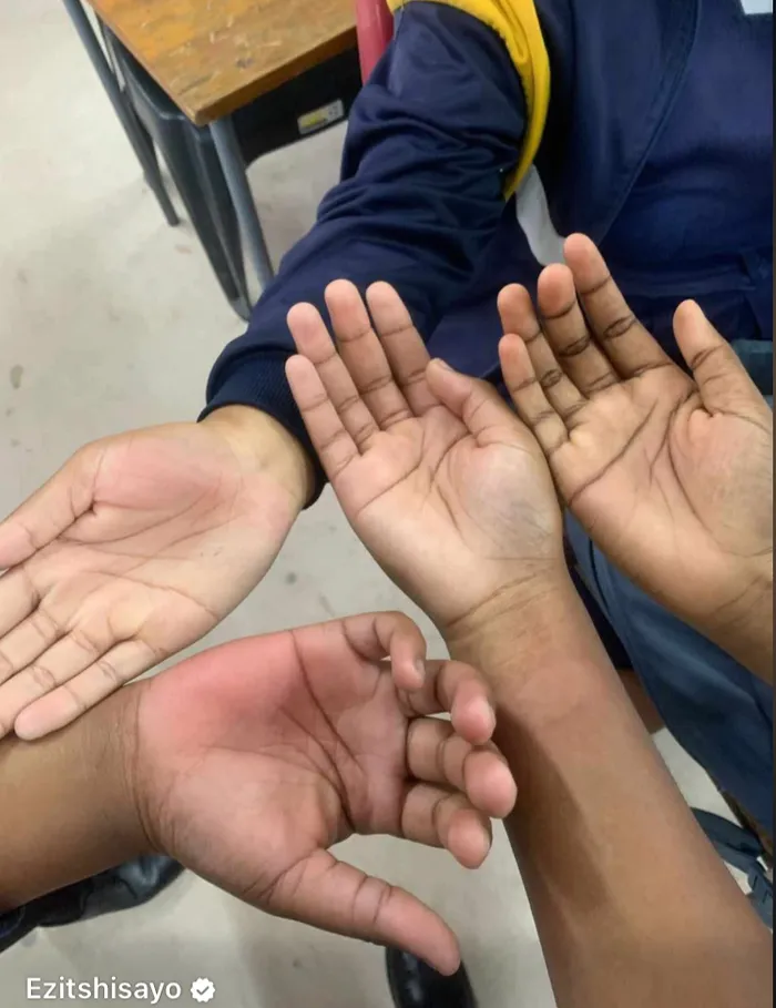 Learners at New Eisleben High School allege their hands were left red and swollen after being struck by teachers as a form of discipline.