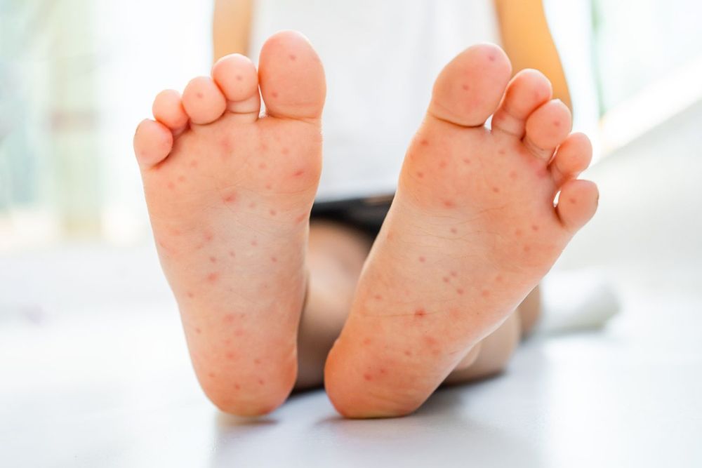 Four adults infected with Hand, Foot and Mouth Disease in KZN