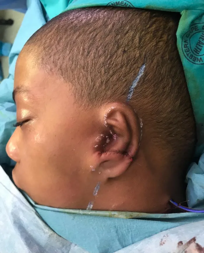 Tygerberg Hospital shines a spotlight on craniofacial birth defects