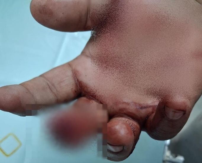 Samoosa Shop Brawl: Customer Bites Off Finger – IOL News