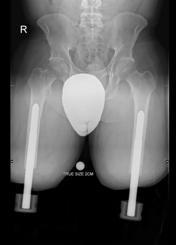 Pre-operative radiograph with bilateral above-knee socket prostheses
