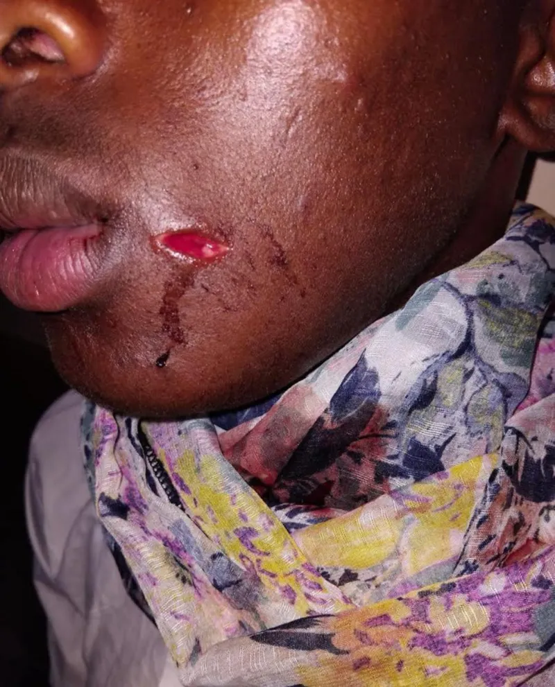 Mbumbulu factional violence spills into school as learner’s jaw is broken in brutal assault