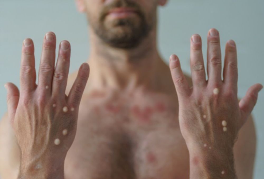 Gauteng strengthens preparedness after three Mpox cases - IOL