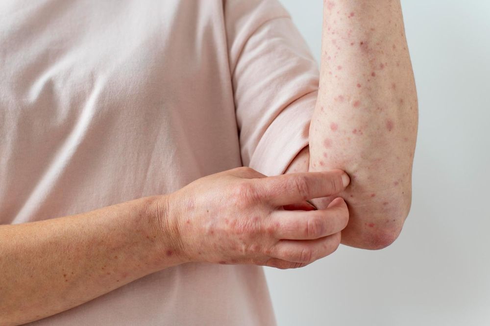 Mpox in South Africa: What you need to know about symptoms, spread, and treatment - IOL