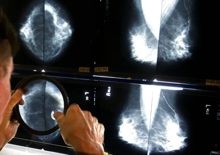 During a mammogram the breast tissue is spread out and compressed between plates.(AP Photo/Damian Dovarganes, File)