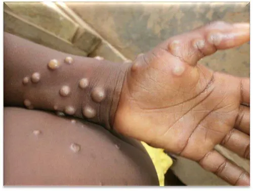 Mpox alert: Cases surge to 18 in SA as Western Cape bears brunt