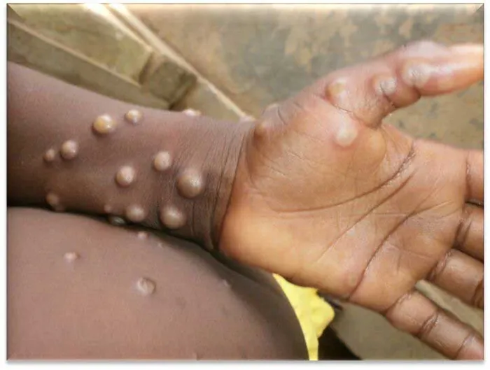 South Africa Reports Rise in Mpox Cases