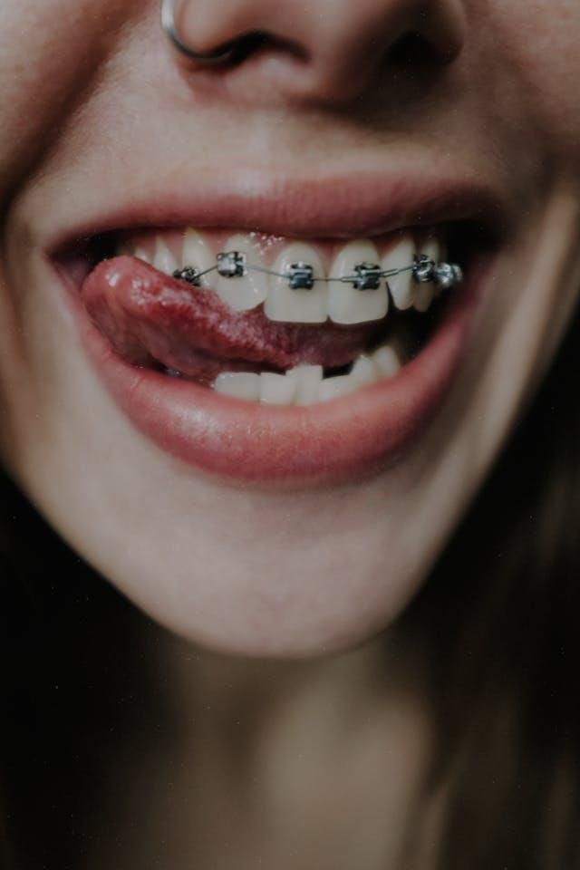 The surprising health advantages of braces and aligners