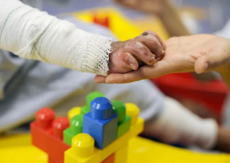 Gauteng health officials warn of rising burn injuries among children as winter sets in