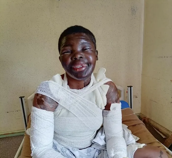 Limpopo woman speaks out after ex's jealous lover 'burned' her with acid