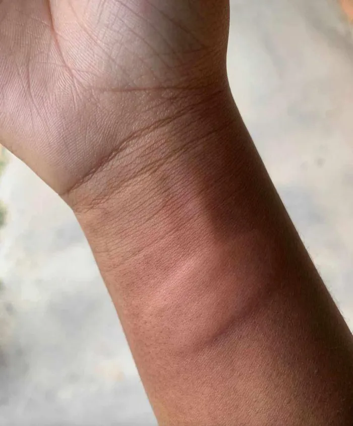 A learner at Luhlaza Secondary School alleges this swollen area on the wrist was caused after being struck by a teacher. The allegations are being investigated by the Western Cape Education Department.