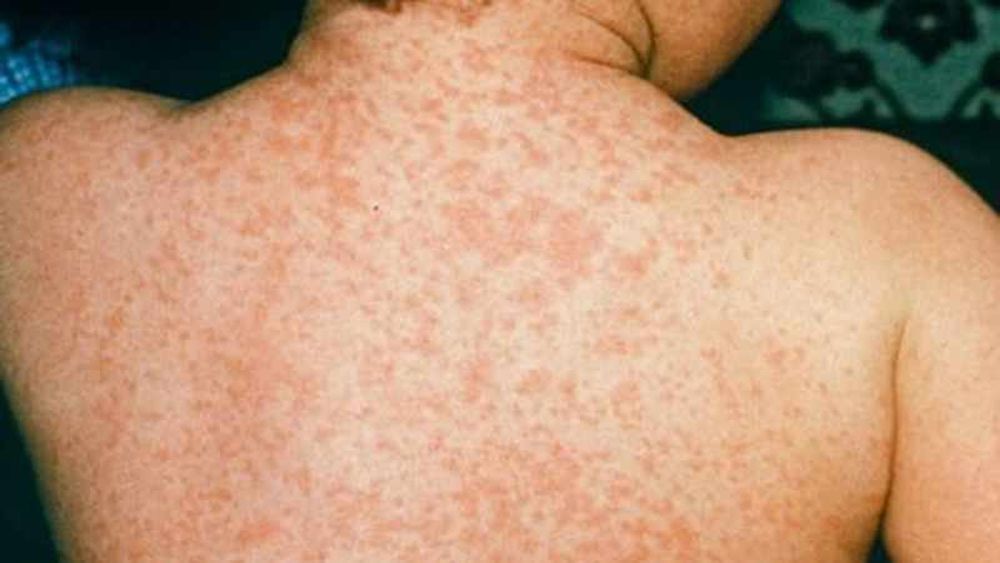 Rising measles outbreaks in South Africa amid falling vaccination rates